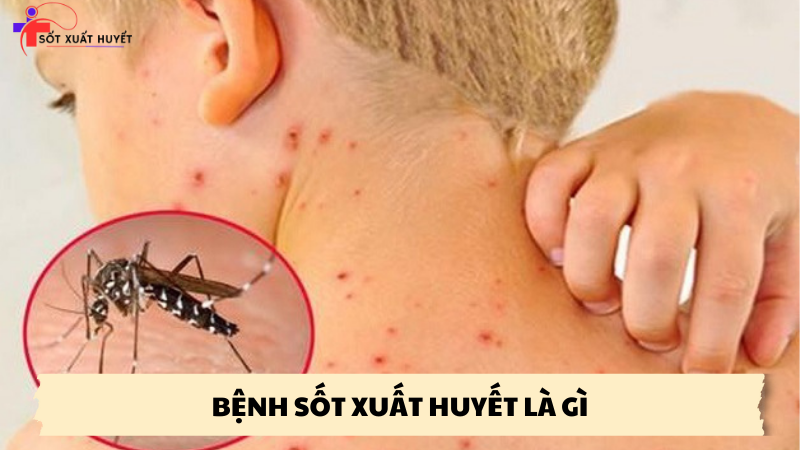 bệnh sốt xuất huyết là gì