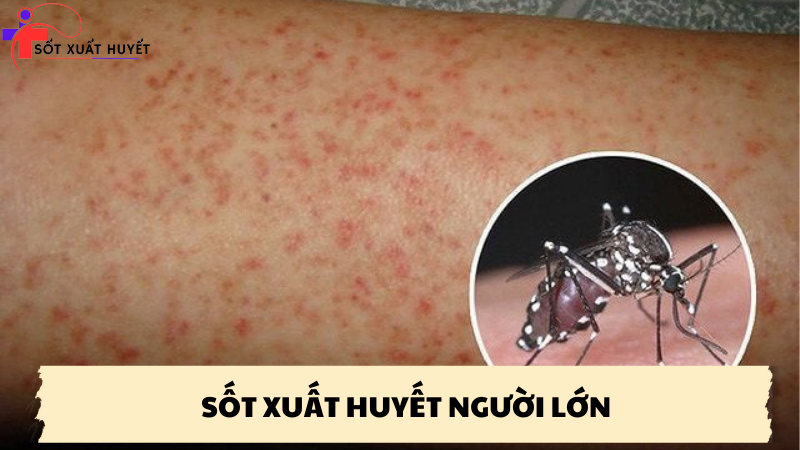 sốt xuất huyết người lớn